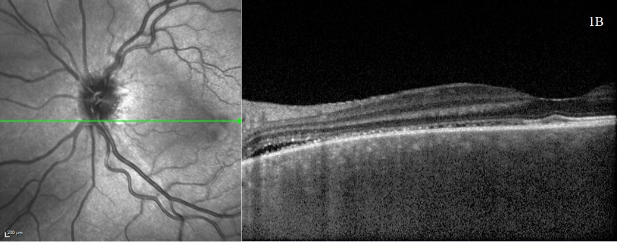 Diagnosis And Management Of Vogt Koyanagi Harada Disease In A