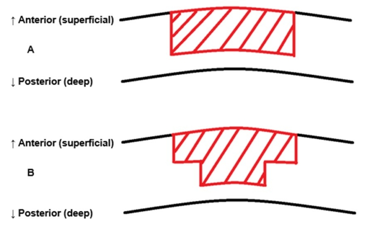 Review of the Femtosecond Laser in DALK Surgery - Journal of the ...